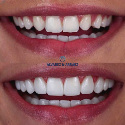 Niche Utama 2 Before And After Smile Design, Veneers - Álvarez & Arráez Odontología