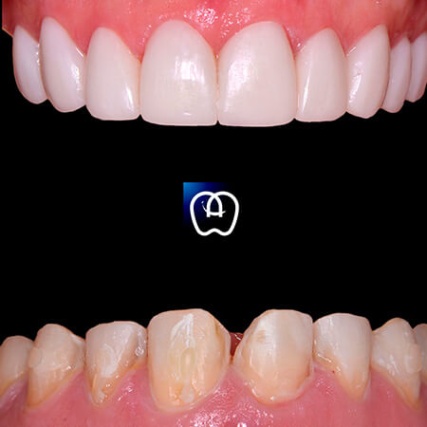 alvarez smile design Niche Utama 2 Before and after Veneers, Smile design - Álvarez & Arráez Odontología